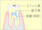 軽度のむし歯（C1）