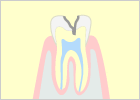 中度のむし歯（C2）