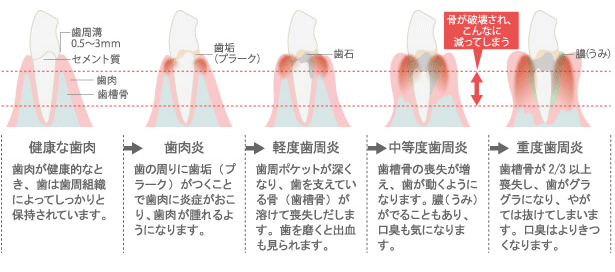 歯周病の進行